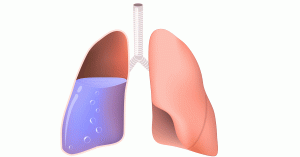 ما هي وذمة الرئة؟