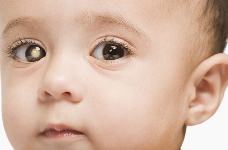 ورم الشبكية لدى الأطفال