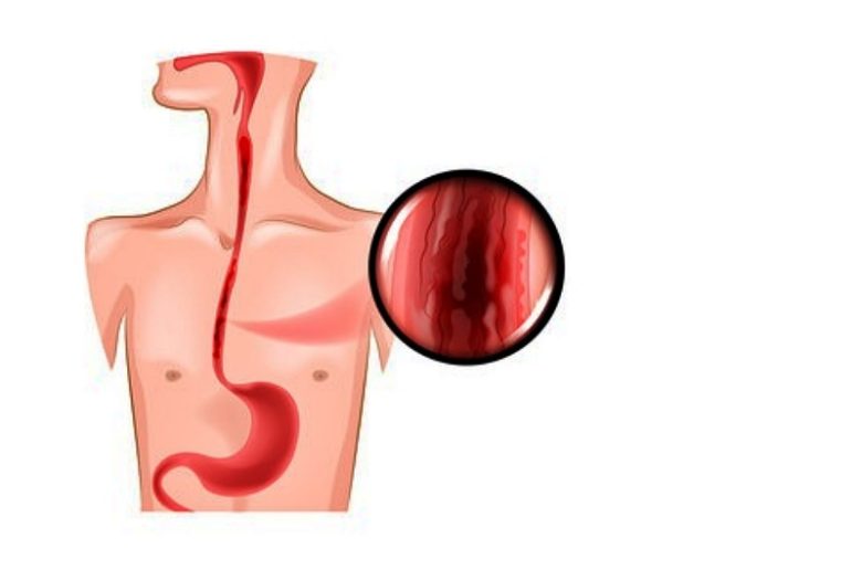 دوالي المريء.. ما هي؟ وكل ما يتعلق بها من معلومات دوالي المريء.. ما هي؟ وكل ما يتعلق بها من معلومات
