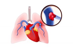أسباب الجلطة الرئوية المفاجئة
