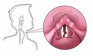 أسباب بحة الصوت عند الأطفال