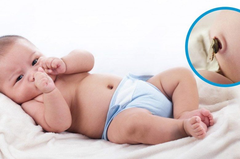 التهاب السرة لدى حديثي الولادة