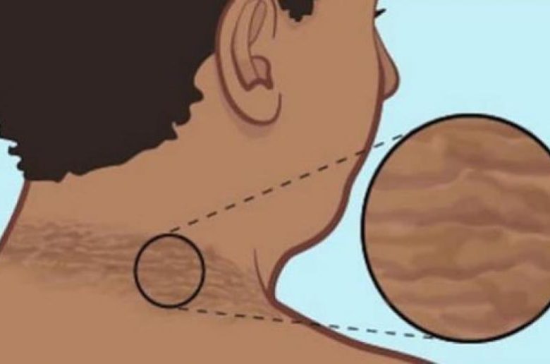 الشواك الأسود