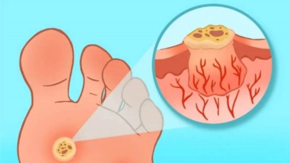 ثآليل عين السمكة