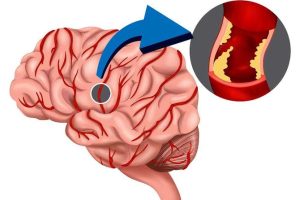 حول علامات السكتات الدماغية