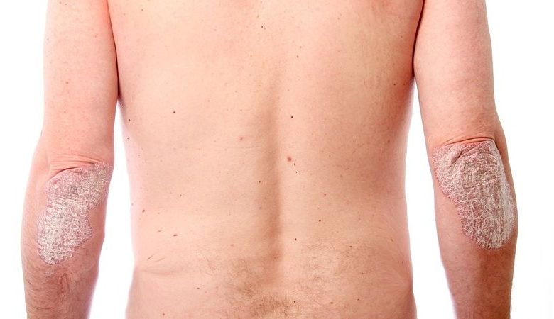 مشكلة التينيا