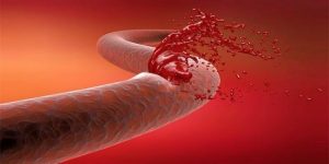 زيادة مخاطر التعرض للنزيف