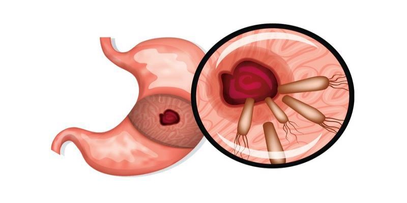 أسباب تكرار الإصابة بالقرحة الهضمية