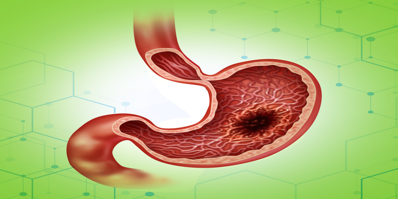 أنواع القرح الهضمية التي تصيب المعدة