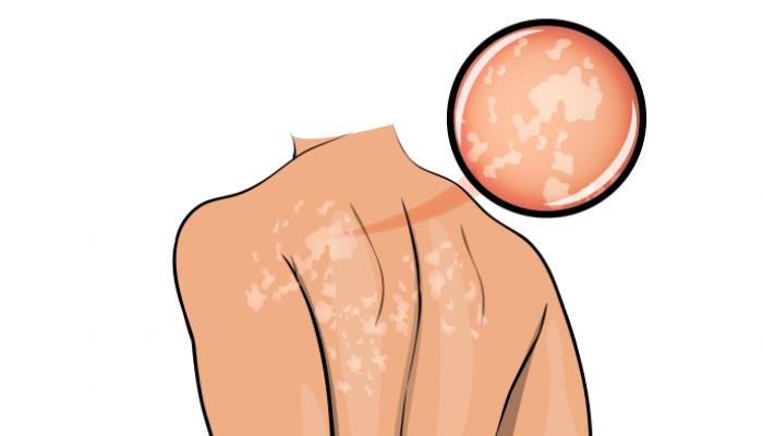 السعفة المبرقشة السعفة المبرقشة