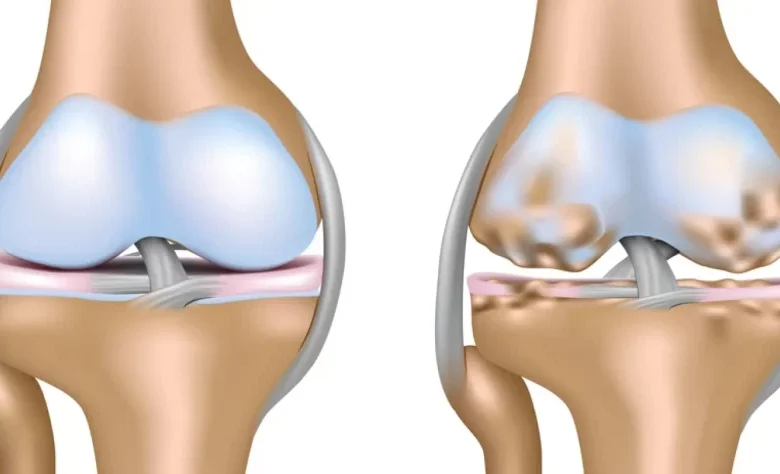 جفاف السائل الزلالي من الركبة جفاف السائل الزلالي من الركبة