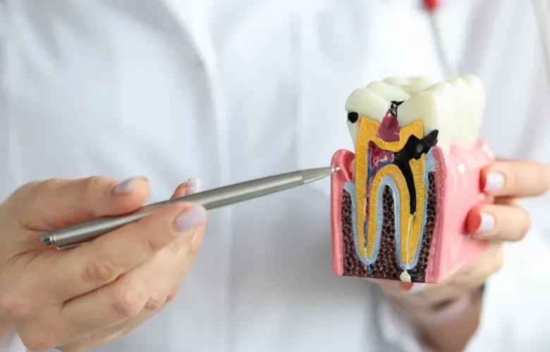 حشو عصب السن