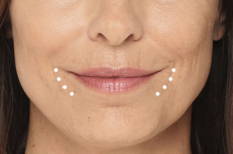 خطوط الماريونيت