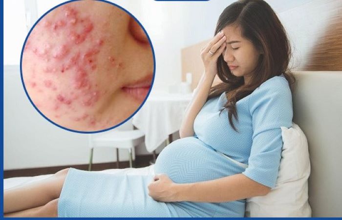 طرق علاجية لحب الشباب لدى النساء الحوامل طرق علاجية لحب الشباب لدى النساء الحوامل