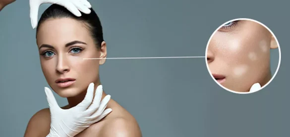 فيتامينات يؤدي نقصها لظهور بقع بيضاء على الجلد