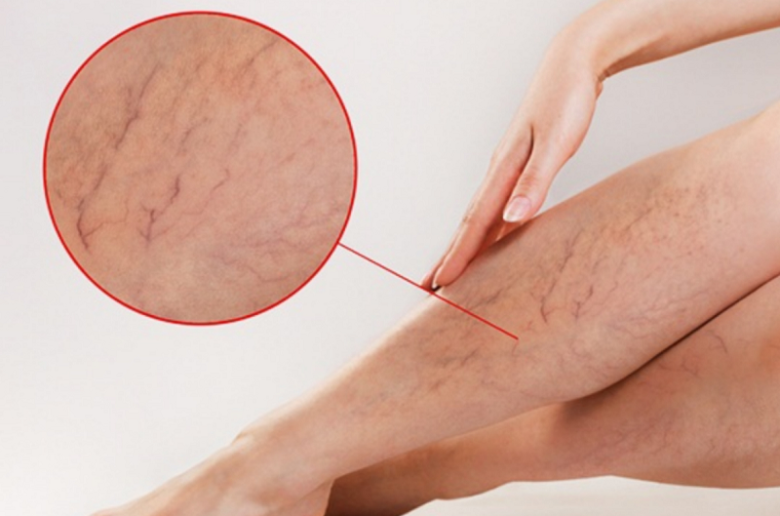 ما هي الدوالي الداخلية؟