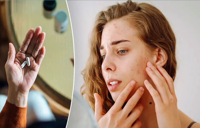 ما هي الفيتامينات والمعادن التي تقلل من ندبات حب الشباب؟