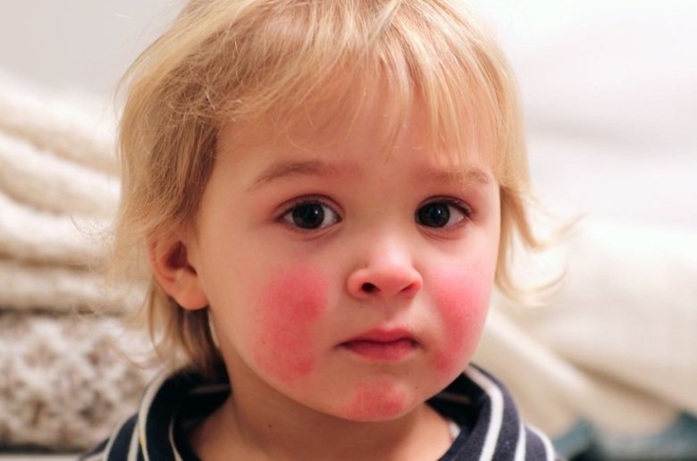 متلازمة الخد المصفوع