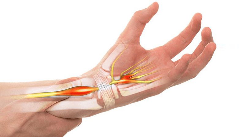 متلازمة النفق الرسغي