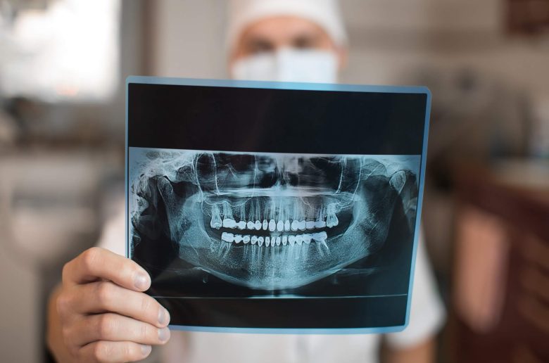 أسباب إجراء أشعة الأسنان