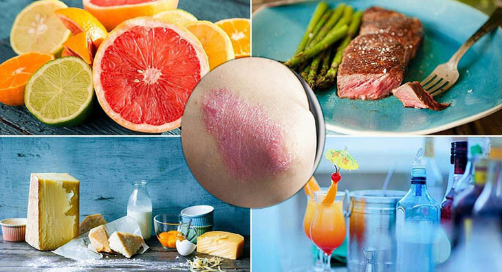 أنواع  من الأطعمة ممنوعة لمرضى الصدفية