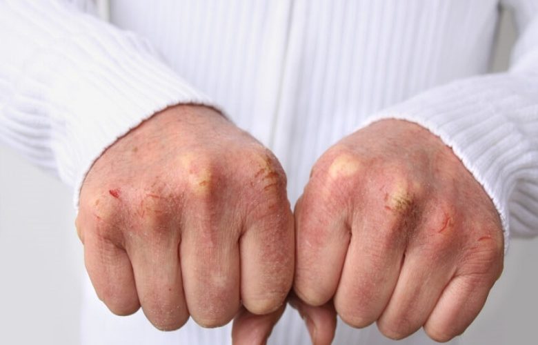 الآلية الصحيحة للتغلب على جفاف بشرة اليدين خلال فصل الشتاء الآلية الصحيحة للتغلب على جفاف بشرة اليدين خلال فصل الشتاء