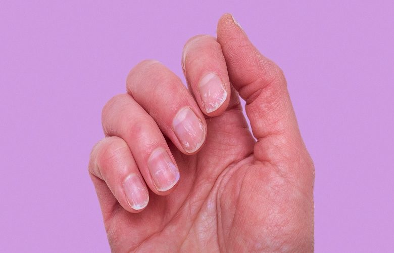 الأظافر الهشة والضعيفة وطرق العناية المثالية بها