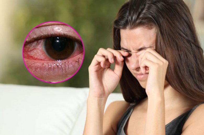 التهاب القرنية الشوكيمبي التهاب القرنية الشوكيمبي