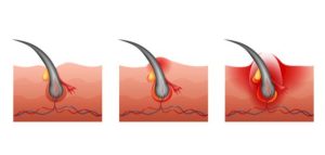 التهاب بصيلات الشعر