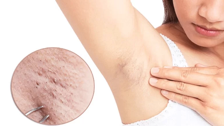 ظهور الحبوب على الجلد بعد إزالة الشعر ظهور الحبوب على الجلد بعد إزالة الشعر