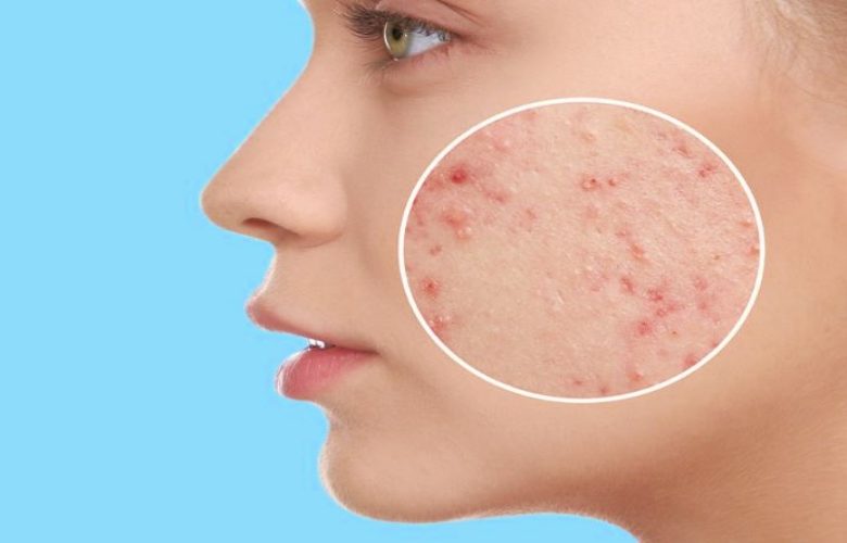 نصائح فعالة للعناية بالبشرة بعد التعافي من بثور حب الشباب
