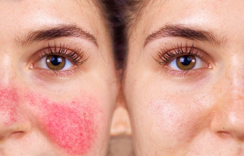 6 خطوات لتدعيم سُبل تعافي البشرة الحساسة والمتهيجة