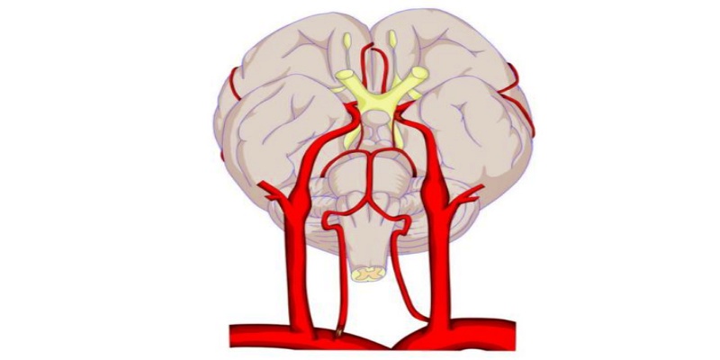 أسباب المعاناة من انسداد الأوعية الدموية الدماغية