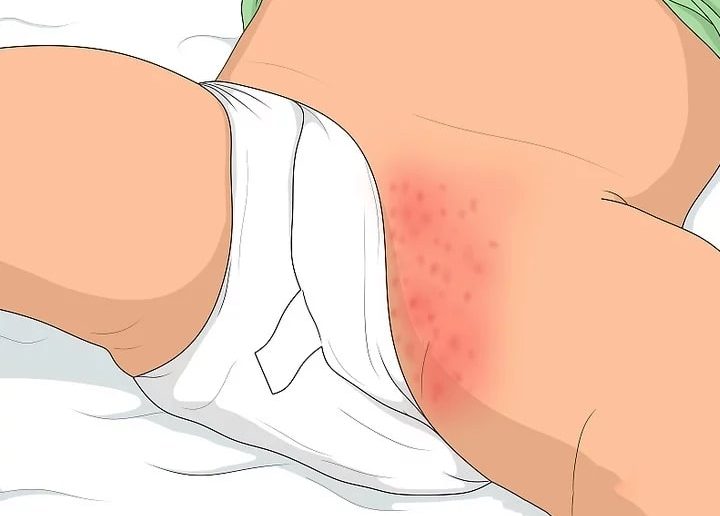 أضرار عن ارتداء الرضع للحفاضات لفترة طويلة