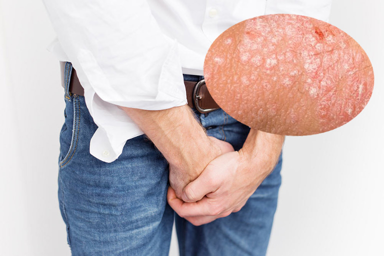 اكزيما المناطق الحساسة