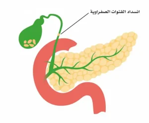 انسداد القنوات المرارية لدى الرضع