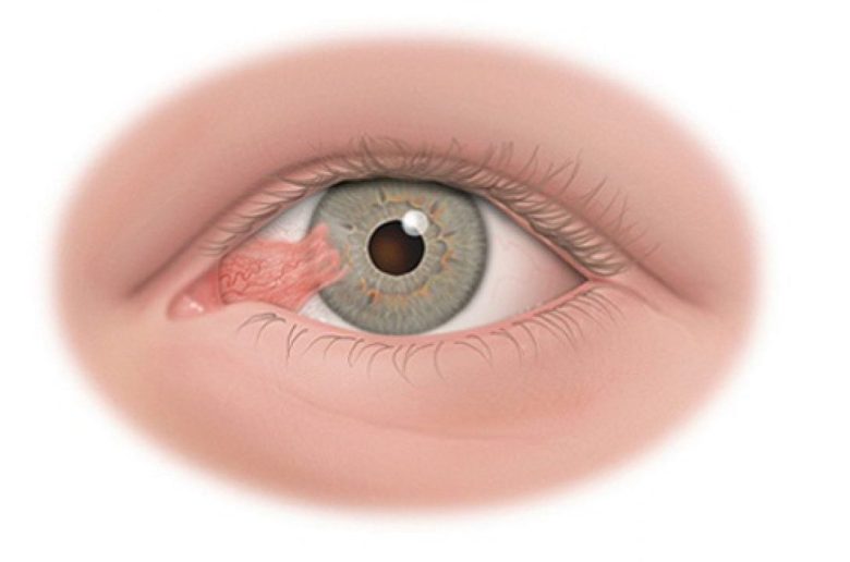 علامات تحذيرية دالة على وجود كيس مائي في العين