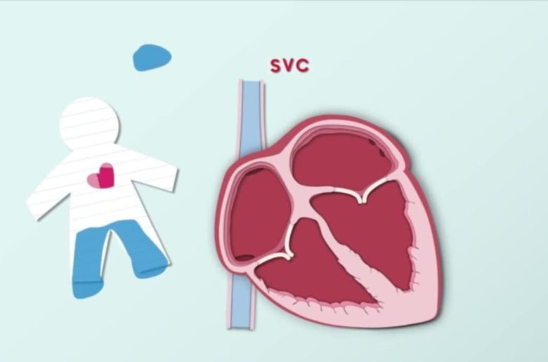 عيوب الحاجز الأذيني لدى الأطفال