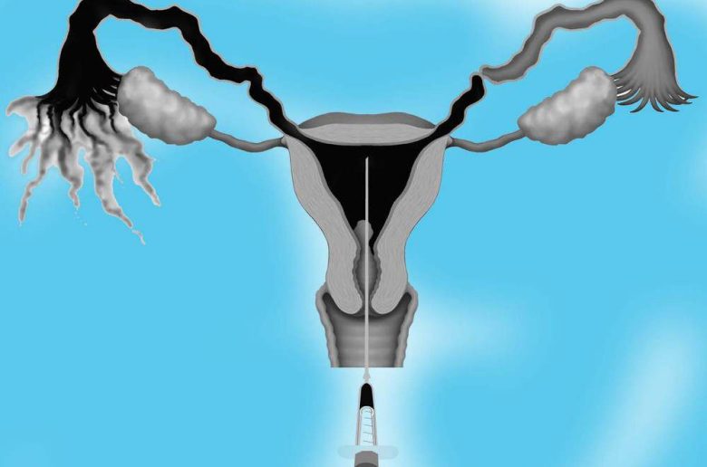 فحص أشعة الصبغة