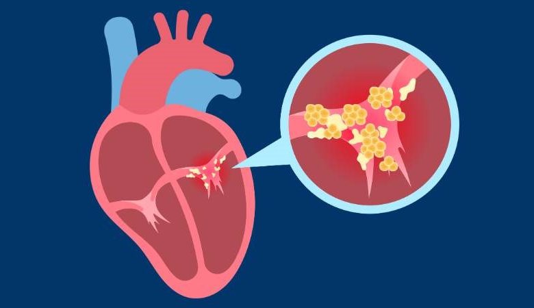 التهاب الشغاف لدى البالغين
