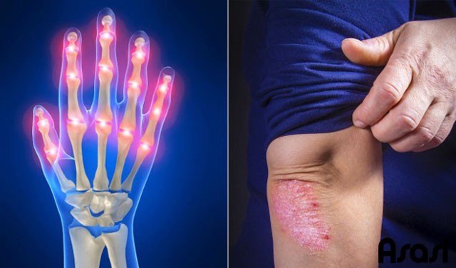 التهاب المفاصل الصدفي