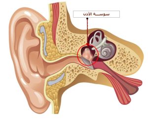 الـأسباب الشائعة لتسوس الأذن
