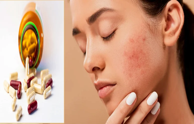 ما هي المكملات الغذائية التي يمكن أن تسبب ظهور حب الشباب؟