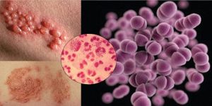 الأمراض المنقولة جنسيا