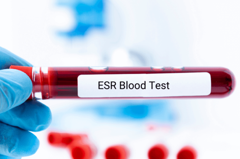 تحاليل للكشف عن وجود التهابات في الجسم