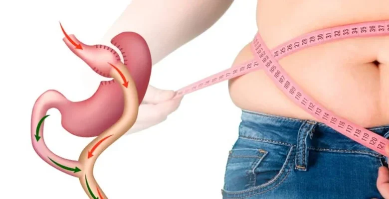 تدابير وقائية للمحافظة على الوزن بعد جراحات السمنة