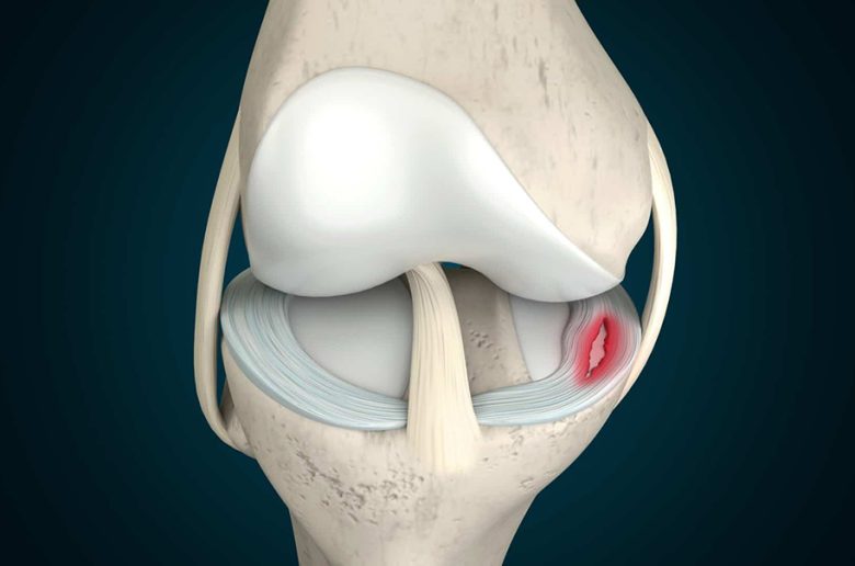 تمزق الغضروف الهلالي