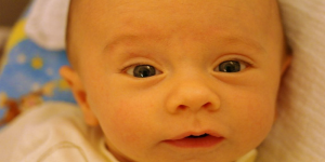 علامات اليرقان عند حديثي الولادة