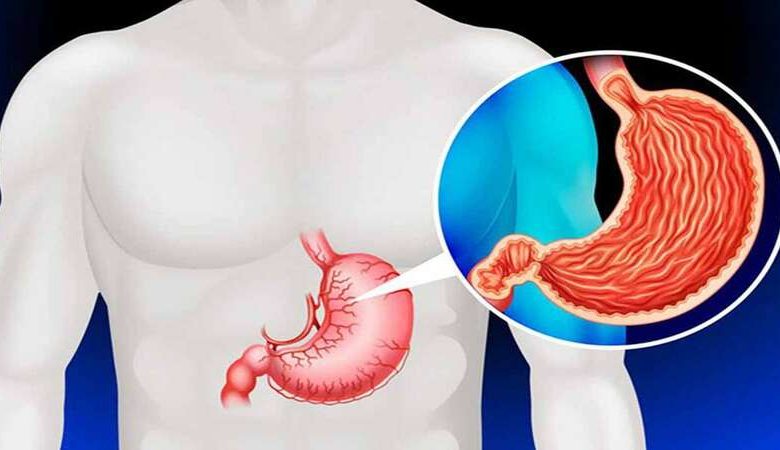 متلازمة الإغراق