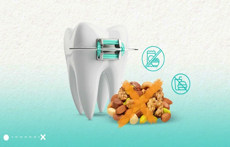 نصائح هامة يجب إتباعها عند ارتداء تقويم الأسنان